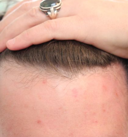 HAIRMDL® — As a male concerned about my hair loss, HAIRMDL® has been a game-changer for me! After just a year of use, my hairline and crown have noticeably improved. I feel like I’ve reclaimed my old hairline. Thank you!