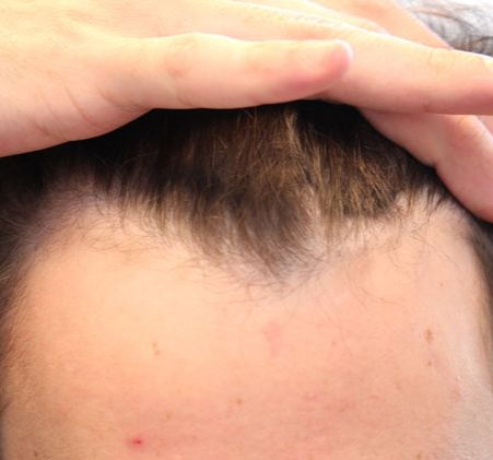 HAIRMDL® — As a male concerned about my hair loss, HAIRMDL® has been a game-changer for me! After just a year of use, my hairline and crown have noticeably improved. I feel like I’ve reclaimed my old hairline. Thank you!