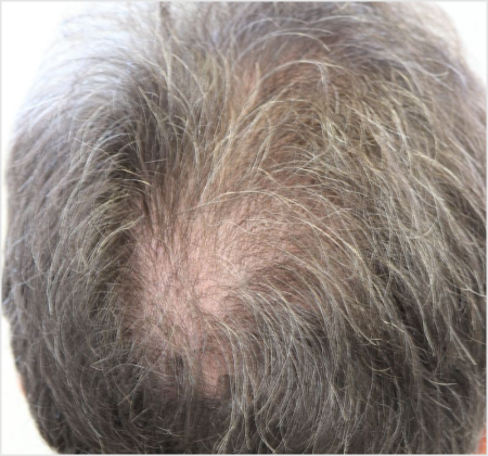 HAIRMDL® — Being a man worried about my bald spot, I was starting to notice it in photos, and even my son pointed it out. It made me feel older than I wanted to. Thankfully, I found HAIRMDL®. It’s made a real difference, and I’m happy to recommend it to others.
