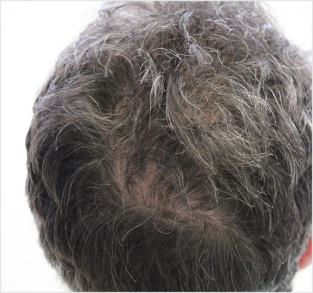 HAIRMDL® — Being a man worried about my bald spot, I was starting to notice it in photos, and even my son pointed it out. It made me feel older than I wanted to. Thankfully, I found HAIRMDL®. It’s made a real difference, and I’m happy to recommend it to others.