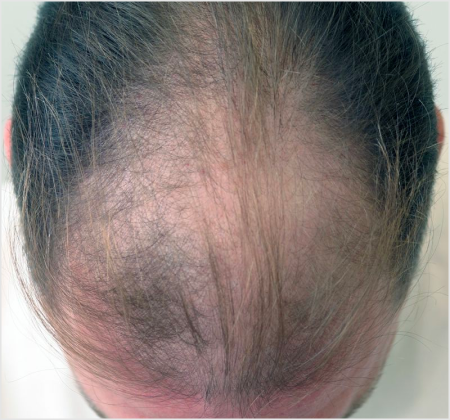 HAIRMDL® — As a longtime patient of Dr. Feinberg in Englewood, NJ, I’ve struggled with thinning hair. About 3 years ago, he started me on his Minoxidil formula, and I’m amazed with the improvement in my hair density. . I highly recommend his product for anyone seeking effective hair restoration.