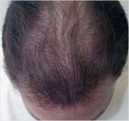 HAIRMDL® — As a longtime patient of Dr. Feinberg in Englewood, NJ, I’ve struggled with thinning hair. About 3 years ago, he started me on his Minoxidil formula, and I’m amazed with the improvement in my hair density. . I highly recommend his product for anyone seeking effective hair restoration.