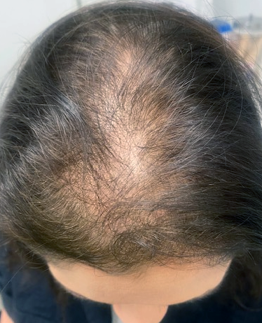 HAIRMDL® — As a female dealing with pattern thinning, I’ve been thrilled with the results of HAIRMDL®. In just one year, I’ve seen remarkable new growth in my hair. Dr. Feinberg shares my excitement about these results and I can’t wait to see even more improvement next year. Thank you, Dr. Feinberg, for restoring my confidence!