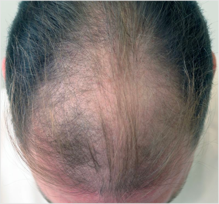 HAIRMDL® — As a longtime patient of Dr. Feinberg in Englewood, NJ, I’ve struggled with thinning hair. About 3 years ago, he started me on his Minoxidil formula, and I’m thrilled with the improvement in my hair density. I highly recommend his product for anyone seeking effective hair restoration.