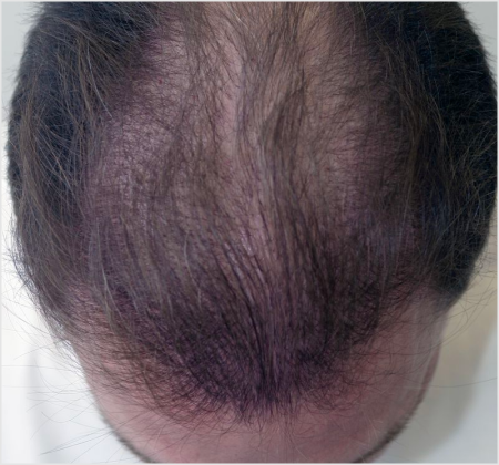 HAIRMDL® — As a longtime patient of Dr. Feinberg in Englewood, NJ, I’ve struggled with thinning hair. About 3 years ago, he started me on his Minoxidil formula, and I’m thrilled with the improvement in my hair density. I highly recommend his product for anyone seeking effective hair restoration.