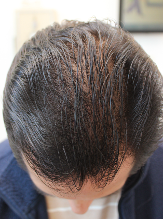 HAIRMDL® — I can’t believe how my hair has grown in so few months. When I first saw Dr Feinberg, I asked about a hair transplant. He thought I should try his medical treatment first. He was so right. He’s an amazing doctor with an amazing product!