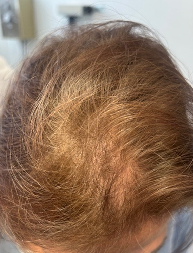 HAIRMDL® — I’m so glad I came to see Dr. Feinberg about my thinning hair nearly a year ago. After trying vitamins and shampoos with no results, HairMDL has truly made a difference. My hair looks fuller and healthier using it every other day. At 61, I’m grateful for the results and for Dr. Feinberg’s care to me and my family for over 20 years.