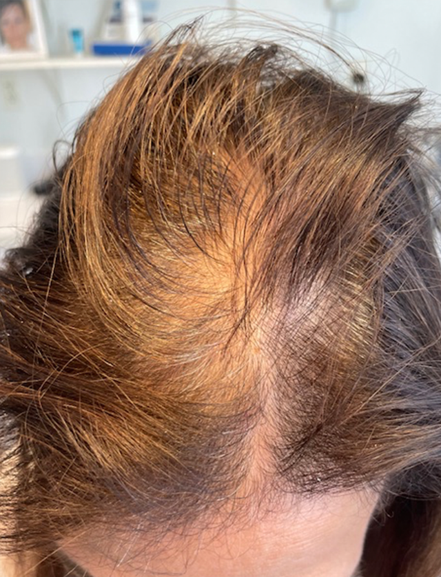 HAIRMDL® — I’m so glad I came to see Dr. Feinberg about my thinning hair nearly a year ago. After trying vitamins and shampoos with no results, HairMDL has truly made a difference. My hair looks fuller and healthier using it every other day. At 61, I’m grateful for the results and for Dr. Feinberg’s care to me and my family for over 20 years.